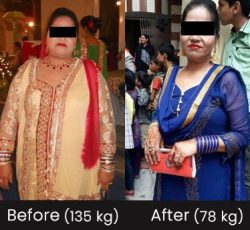 Dr. VIvek Bindal Robotic and Bariatric Surgeon success story