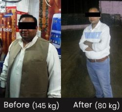 Dr. VIvek Bindal Robotic and Bariatric Surgeon success story